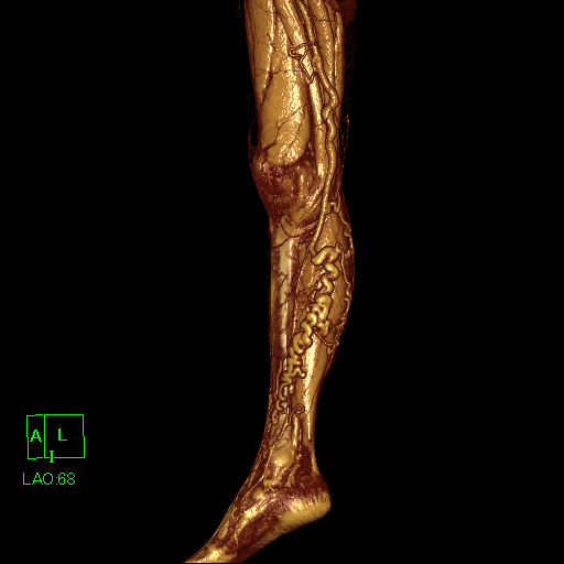 下肢静脈瘤（単純CT）
